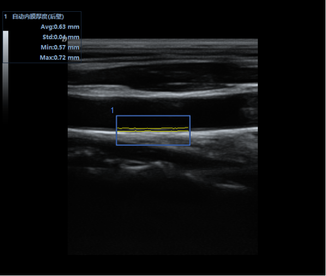 IMT内中膜自动测量
